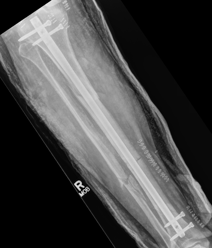 Segmental tibia 2